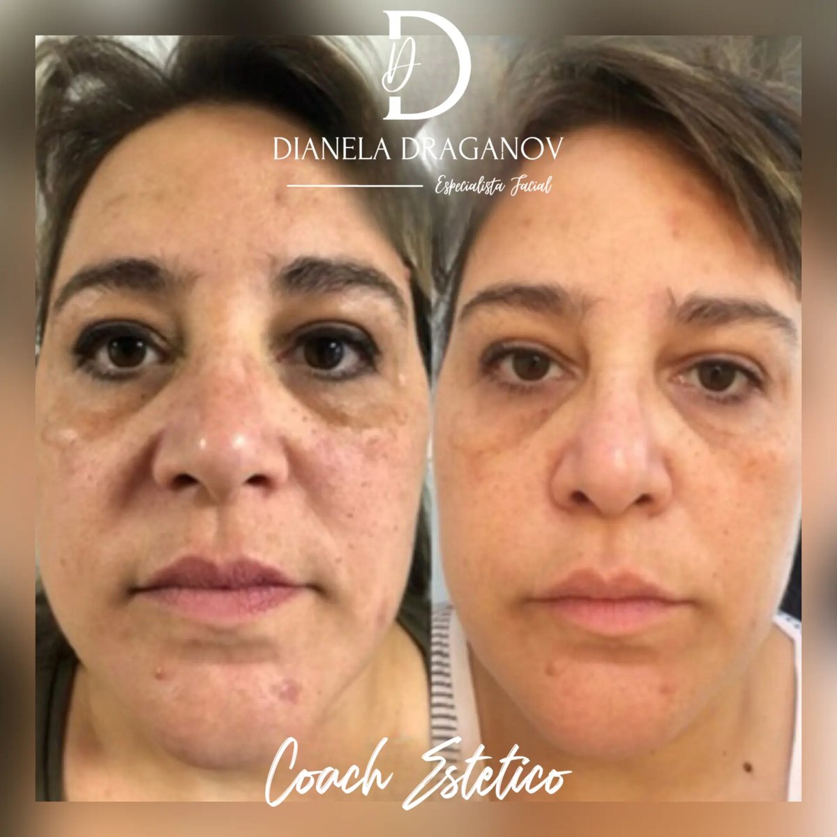 Antes y después: manchas y melasma tratados con peeling químico