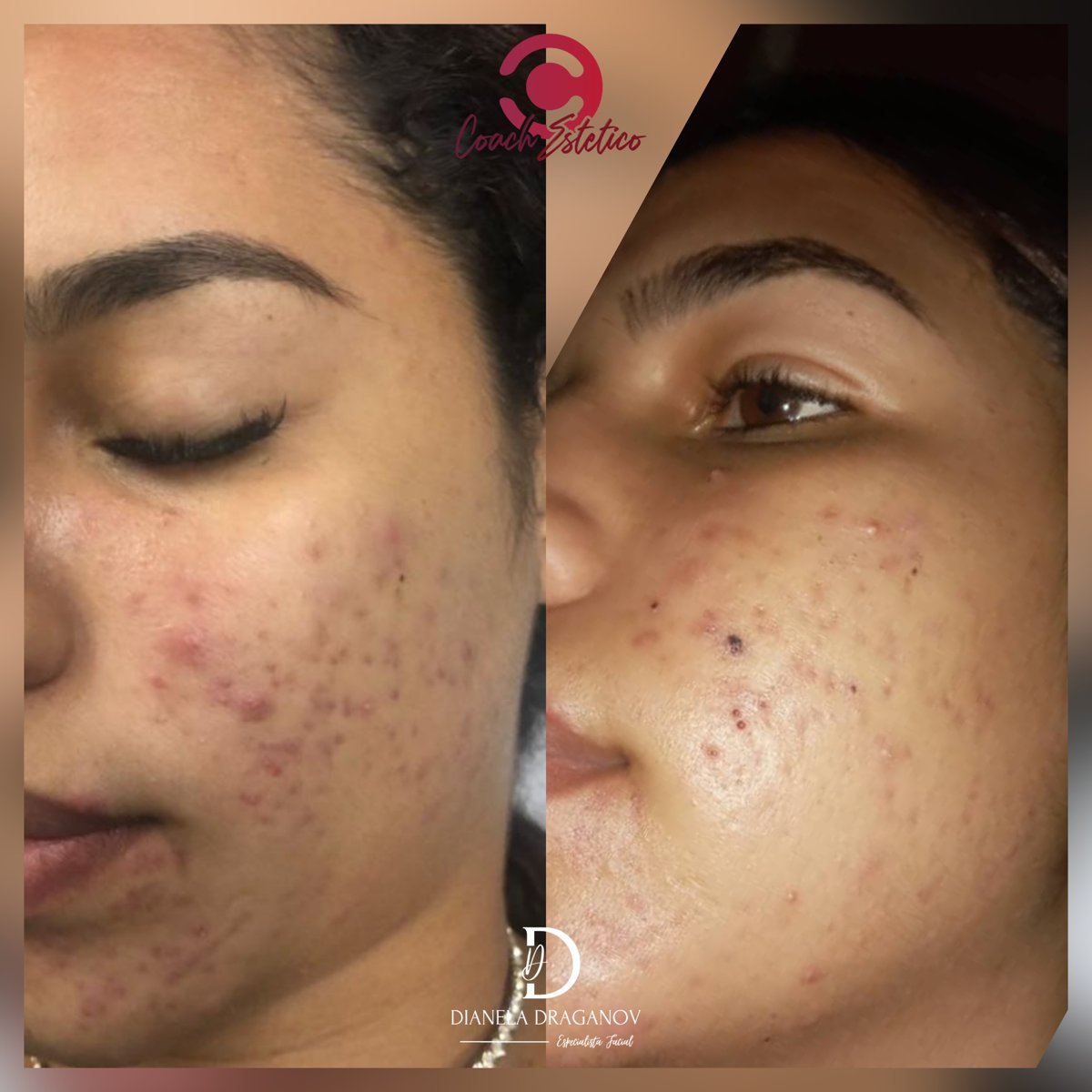 Antes y después de un protocolo con peeling químico