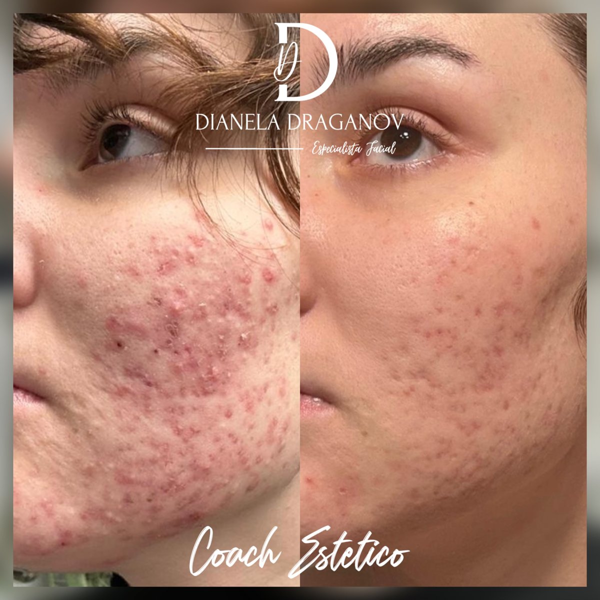 Antes y después de un protocolo con peeling químico