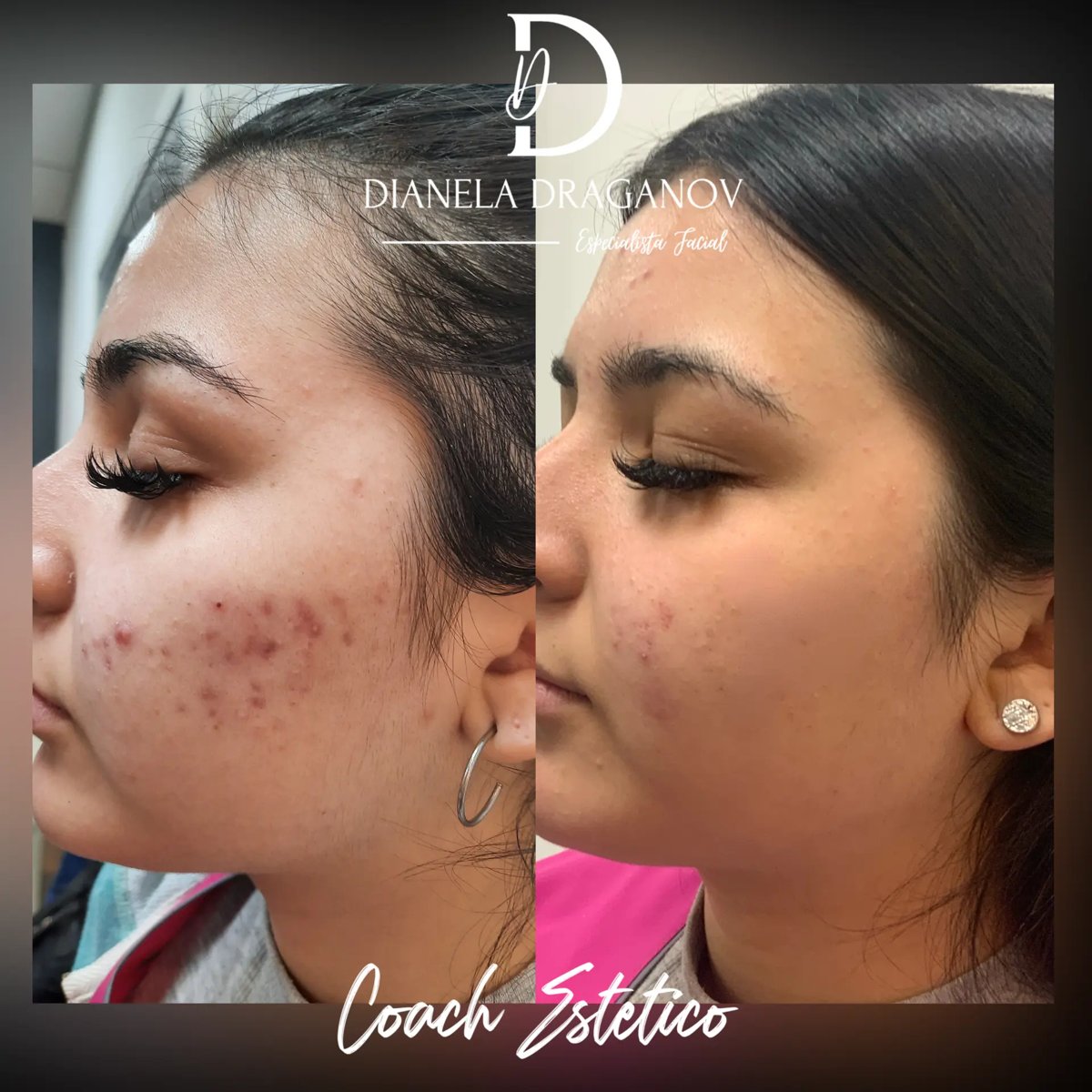 Antes y después: acné en mejilla tratado con peeling químico
